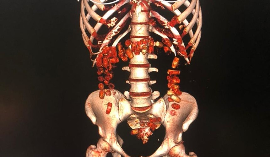 Девушку с полкило кокаина в желудке задержали таможенники во Внуково